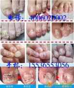 一个脚趾甲嵌甲了带有甲沟炎坚持用了2个周期奥加基本上好了