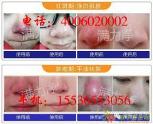 二期酒糟鼻我用了3个周期的满力净好了