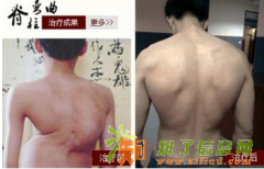 张氏组合疗法之脊柱矫正器