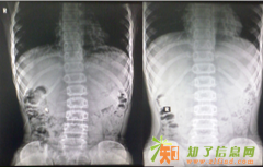 非手术治疗脊柱弯曲的方法