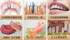 福州种植专家刘斌元谈生物活性种植牙