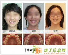 来福州科尔口腔医院做矫正 让您更加魅力四射