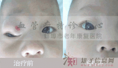 合肥治疗血管瘤价格要多少钱？皖北血管瘤特诊中心