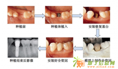 科尔口腔全颌Multi即刻种植牙 引领福州种植牙潮流