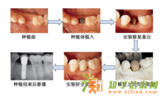 福州科尔口腔医院即刻种植牙 重塑健康牙齿不是梦