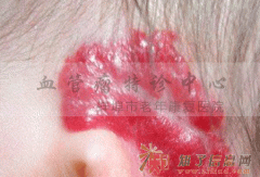 淮南治疗血管瘤多少钱？皖北血管瘤特诊中心报价