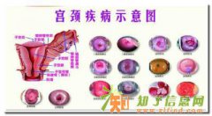 宫颈糜烂治疗注意事项？