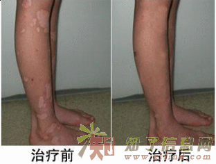 了解鱼鳞病的原因是什么