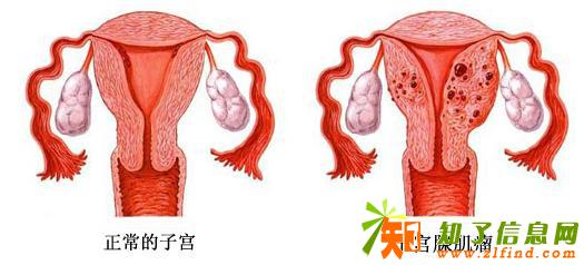 子宫肌瘤怎么办？中医院权威教授教你如何治疗妇科疾病