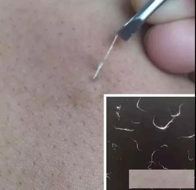 民间绝技挑羊毛疔培训郑州开课