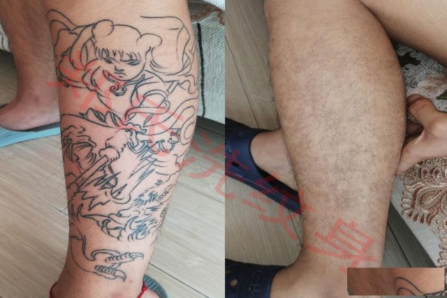 辽阳郑氏洗纹身承接别处洗不掉的所有纹身签约包洗干净