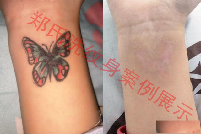洗纹身就到郑氏洗纹身专业技术洗纹身签合同包洗干净