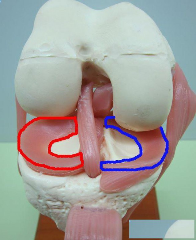 半月板磨损怎样治疗效果最好