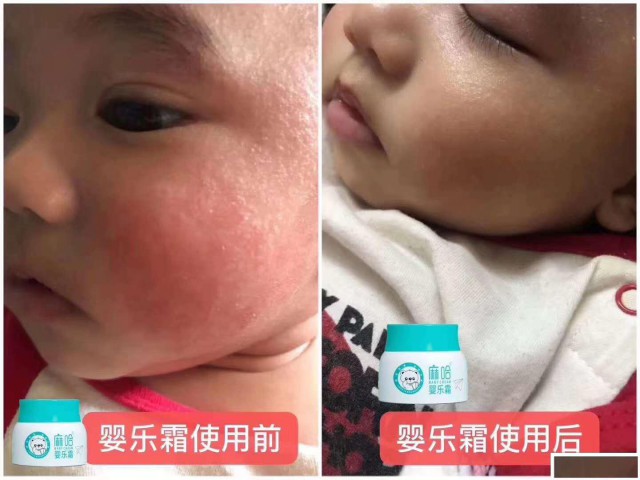 麻哈婴乐霜可以治湿疹吗，麻哈婴乐霜安全吗？价格