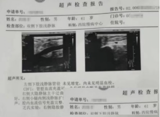 静脉曲张治疗方法有哪些