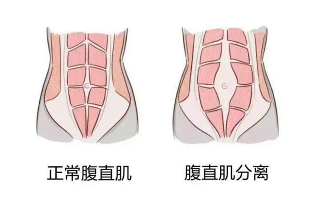 腹直肌分离修复百科