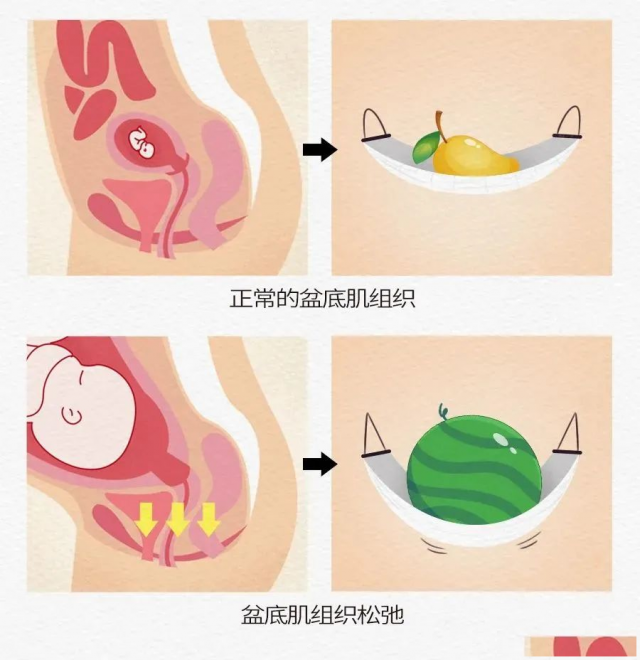 产后盆底肌修复的重要性及好处