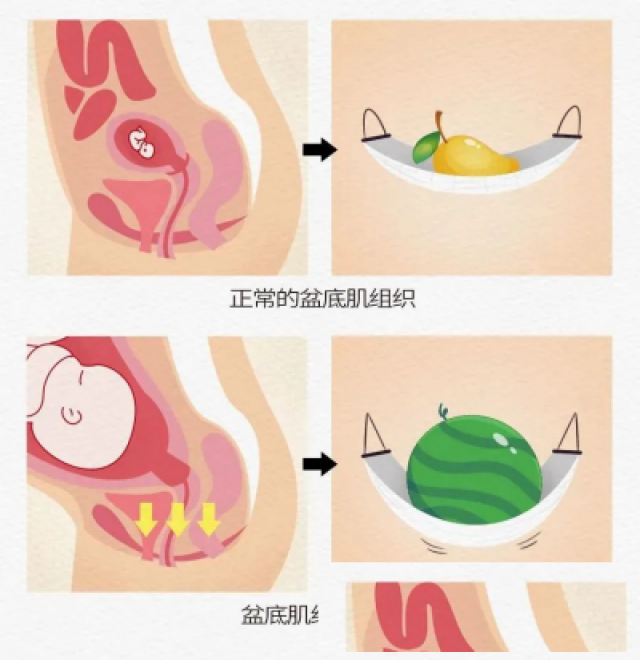 产后盆底肌修复的重要性及好处
