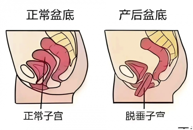 科学产后康复：重焕女性健康活力